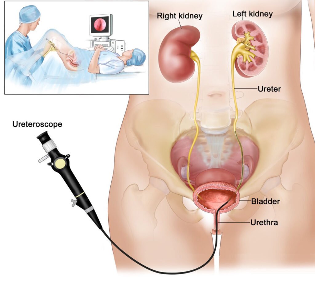 Urology Endoscopic Procedures